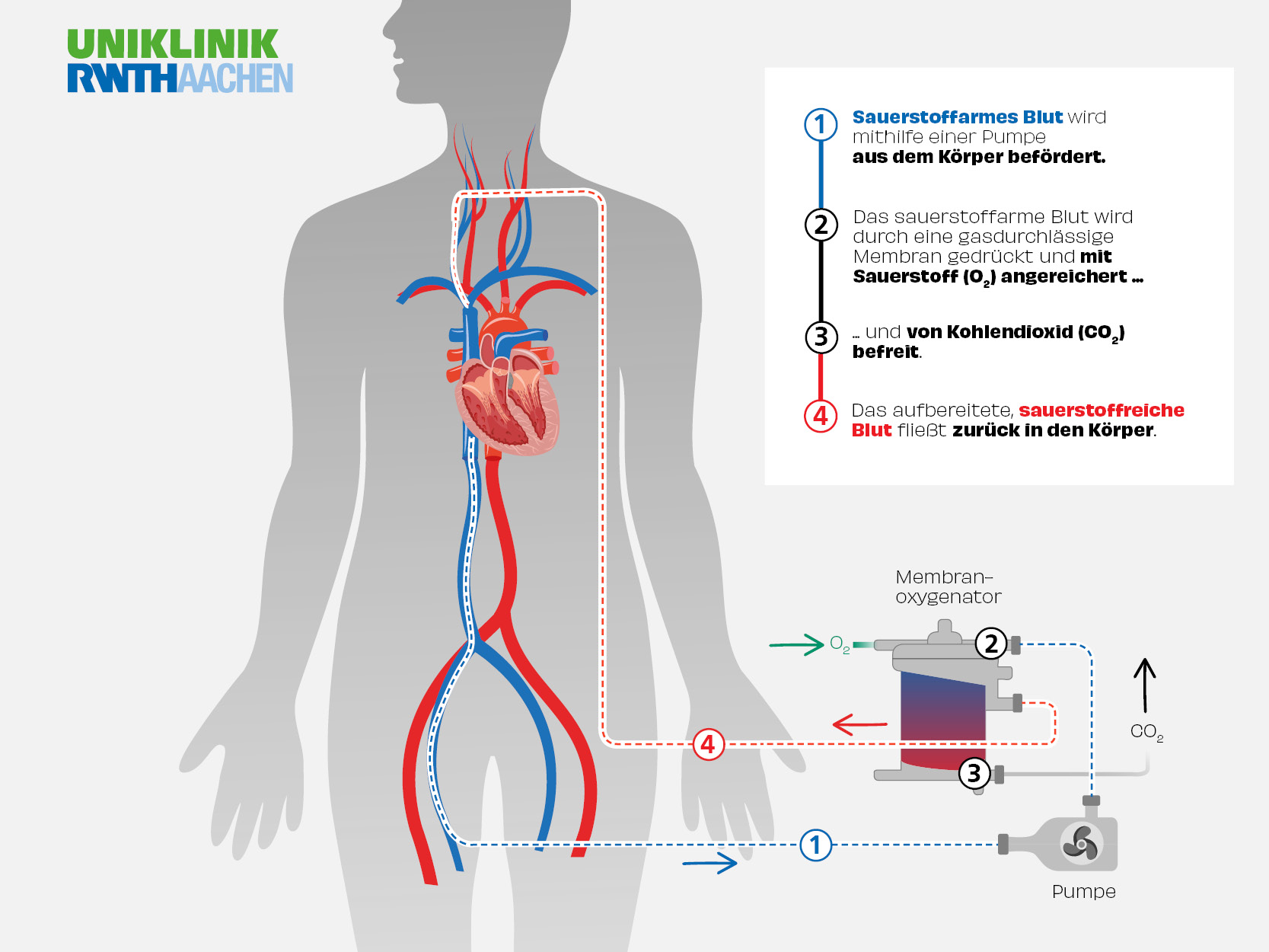 Überleben ECMOTherapie als letzte Hoffnung aproposgesund